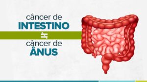 Cancer-intestino-anus-300x169 Cancer-intestino-anus